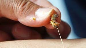 Cách chữa ong đốt không đau, không cần dùng thuốc